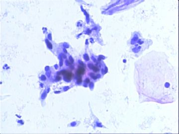 TCT：55岁。镜下：细胞呈萎缩改变，可见部分成团的小梭形细胞。图2