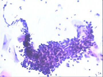 TCT：55岁。镜下：细胞呈萎缩改变，可见部分成团的小梭形细胞。图3