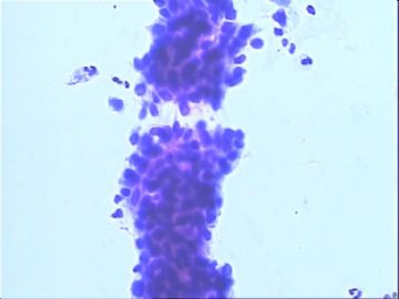 TCT：55岁。镜下：细胞呈萎缩改变，可见部分成团的小梭形细胞。图5