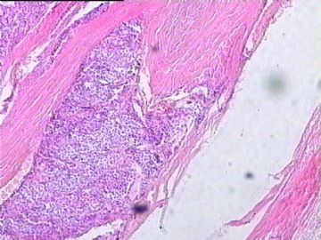 甲状腺癌？请老师们给看看。图1