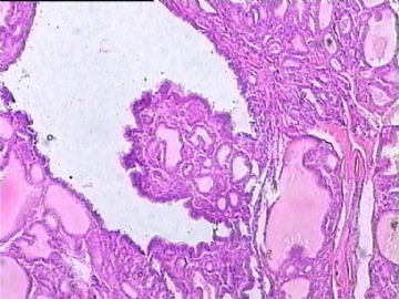 甲状腺癌？请老师们给看看。图4