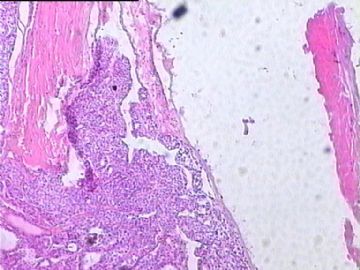 甲状腺癌？请老师们给看看。图6