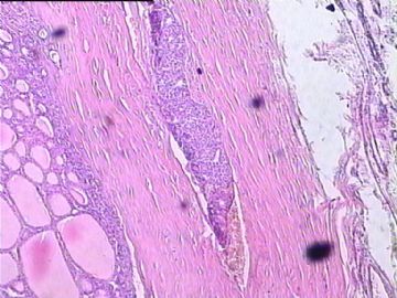 甲状腺癌？请老师们给看看。图12