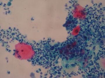 37岁 宫颈糜烂 液基制片  活检上传图4
