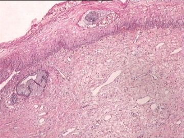 宫颈赘生物：？？？慢性宫颈炎伴鳞化？图7