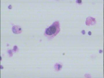 4962011患者，60岁，右锁骨上淋巴结穿刺图4