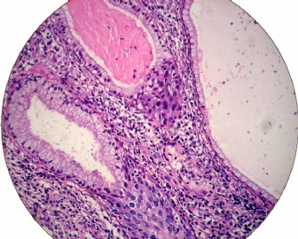 宫颈活检（女35岁，HPV51+，ASCUS）图2