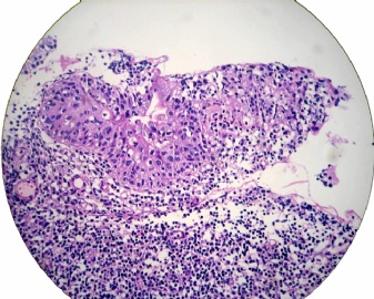 宫颈活检（女35岁，HPV51+，ASCUS）图4