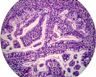 宫颈活检（女35岁，HPV51+，ASCUS）图5