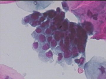 宫颈液基，32岁，活检cin1，术后一年复查，带节育器，分两次传图1图4