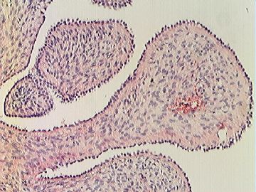 右卵巢表面菜花样赘生物图9