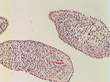 右卵巢表面菜花样赘生物图12