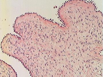 右卵巢表面菜花样赘生物图15