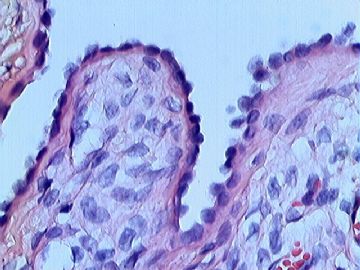 右卵巢表面菜花样赘生物图17