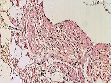 左大腿根部肿物图3