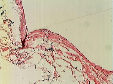 左大腿根部肿物图10