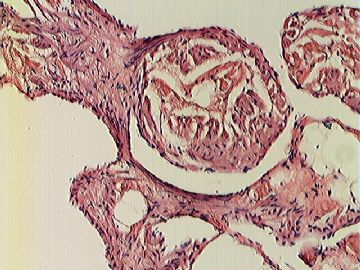 左大腿根部肿物图22