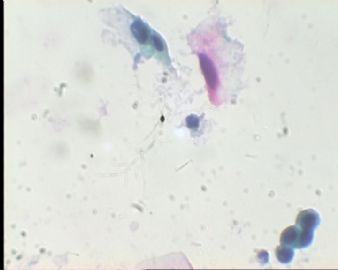 《已确诊CIN3》TCT2023请教图5