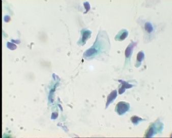 《已确诊CIN3》TCT2023请教图6