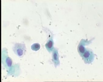 《已确诊CIN3》TCT2023请教图11