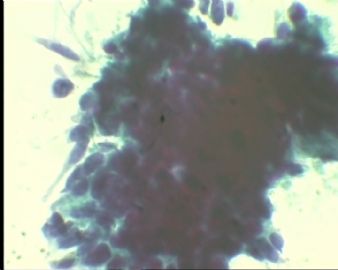 《已确诊CIN3》TCT2023请教图18