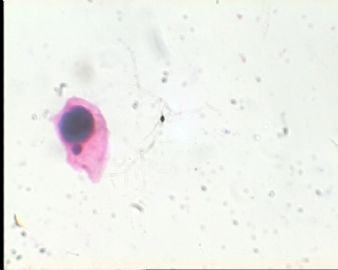 《已确诊CIN3》TCT2023请教图20