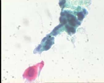 《已确诊CIN3》TCT2023请教图22