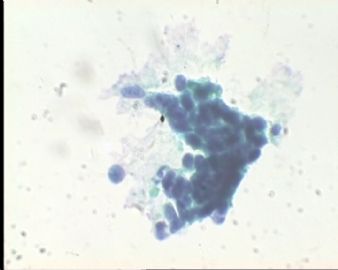 《已确诊CIN3》TCT2023请教图23