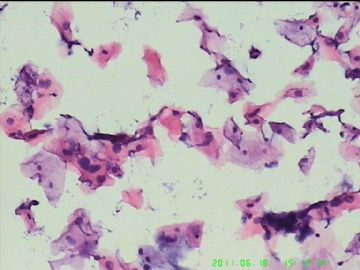 宫颈TCT，活检出来了图1