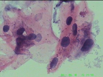 宫颈TCT，活检出来了图2
