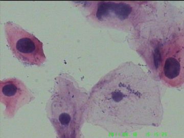 宫颈TCT，活检出来了图3