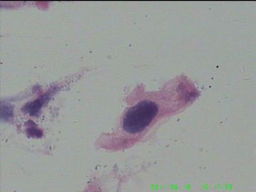 宫颈TCT，活检出来了图5