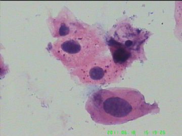 宫颈TCT，活检出来了图6