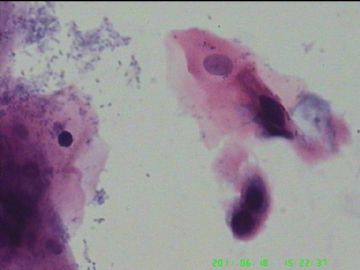 宫颈TCT，活检出来了图9