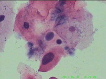 宫颈TCT，活检出来了图10