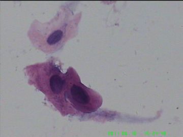 宫颈TCT，活检出来了图14