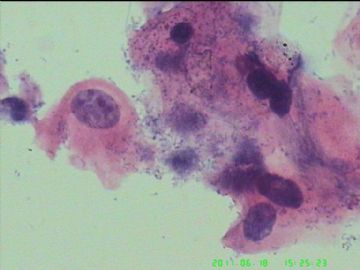 宫颈TCT，活检出来了图15