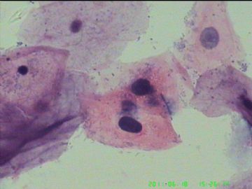 宫颈TCT，活检出来了图16