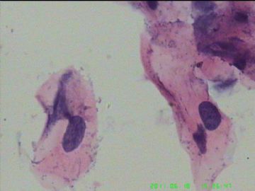 宫颈TCT，活检出来了图17