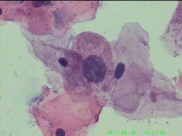 宫颈TCT，活检出来了图18